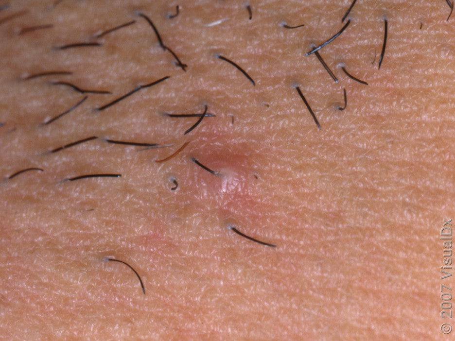 Dermatologist tells you what to know about ingrown hairs.