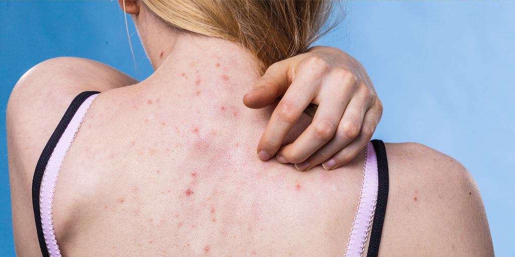 ‘I’m a Dermatologist, and These Are the 8 Best Products for Fighting and Preventing Bacne’