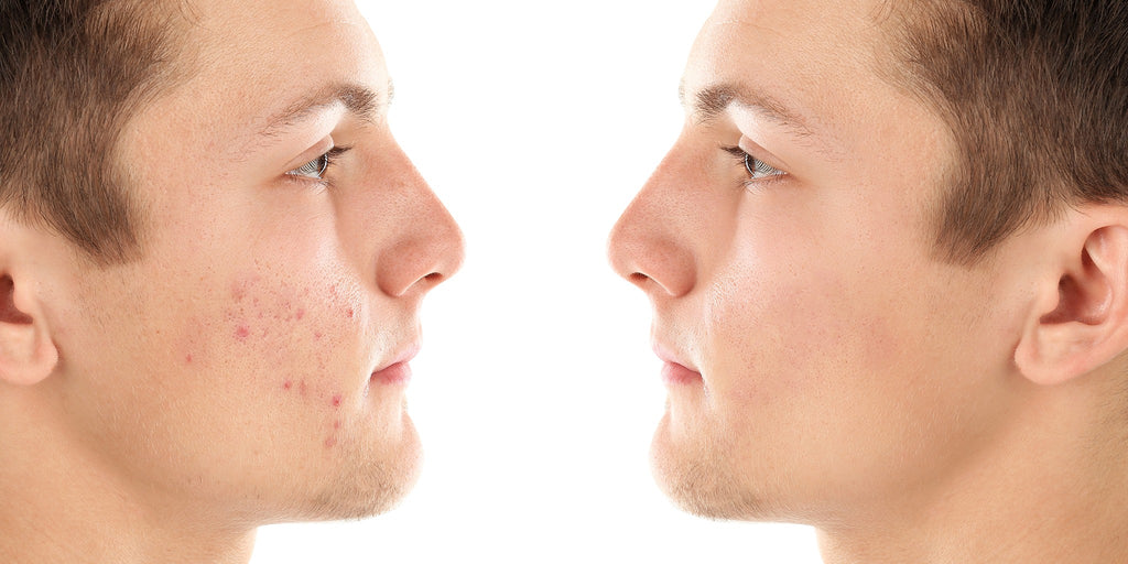 Acne Scars and Dark Spots: Causes and Remedies