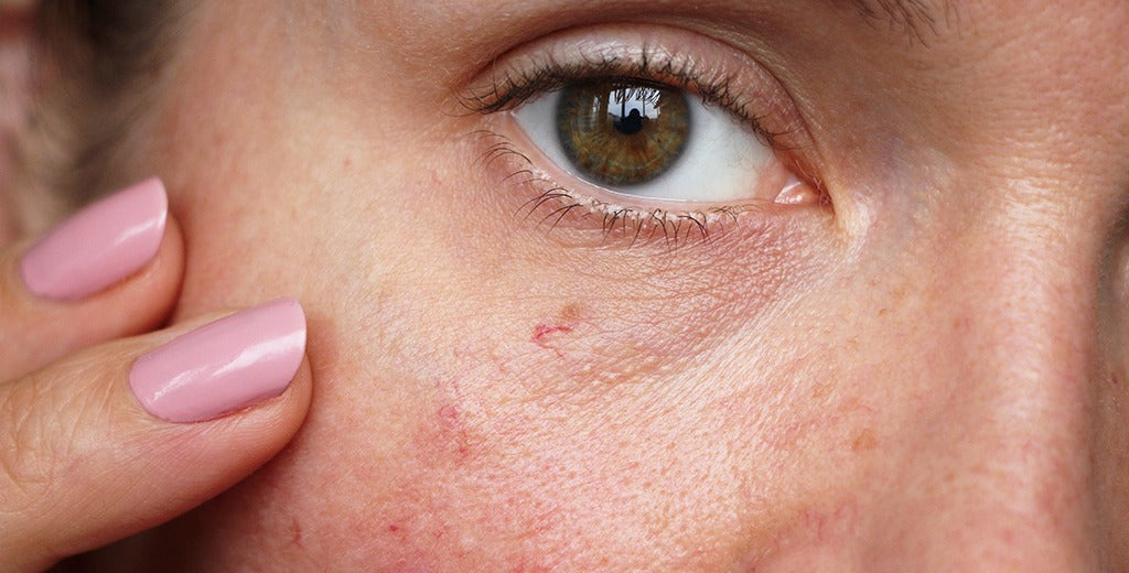Yes, It’s Possible to Get Rid of Hormonal Acne. Here’s How