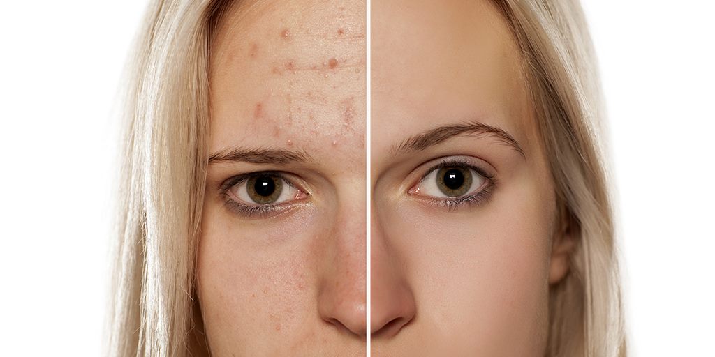 How to Get Rid of Your Red, Indented Acne Scars For Good
