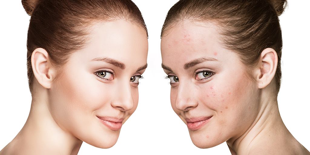 5 products for beautiful skin to use during National Acne Awareness Month