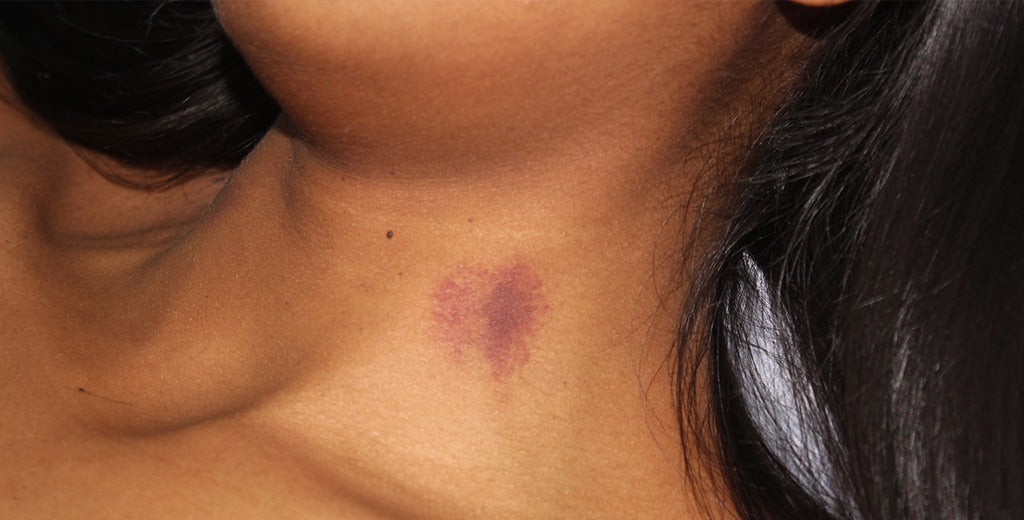 Expert-Approved Tips on How to Hide Your Biggest Hickeys