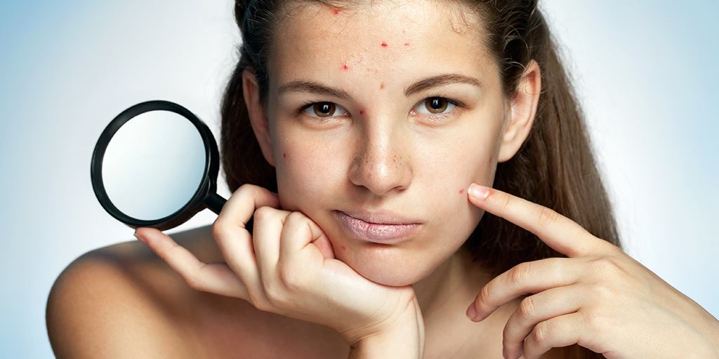 Acne is a part of my life, and I’ve decided to be okay with that