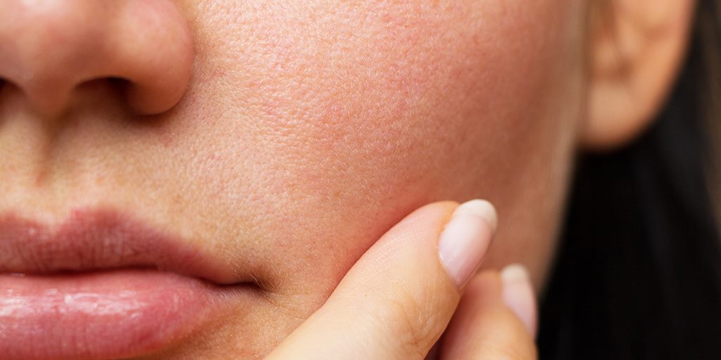 Why pores seem to grow in size over the course of the day
