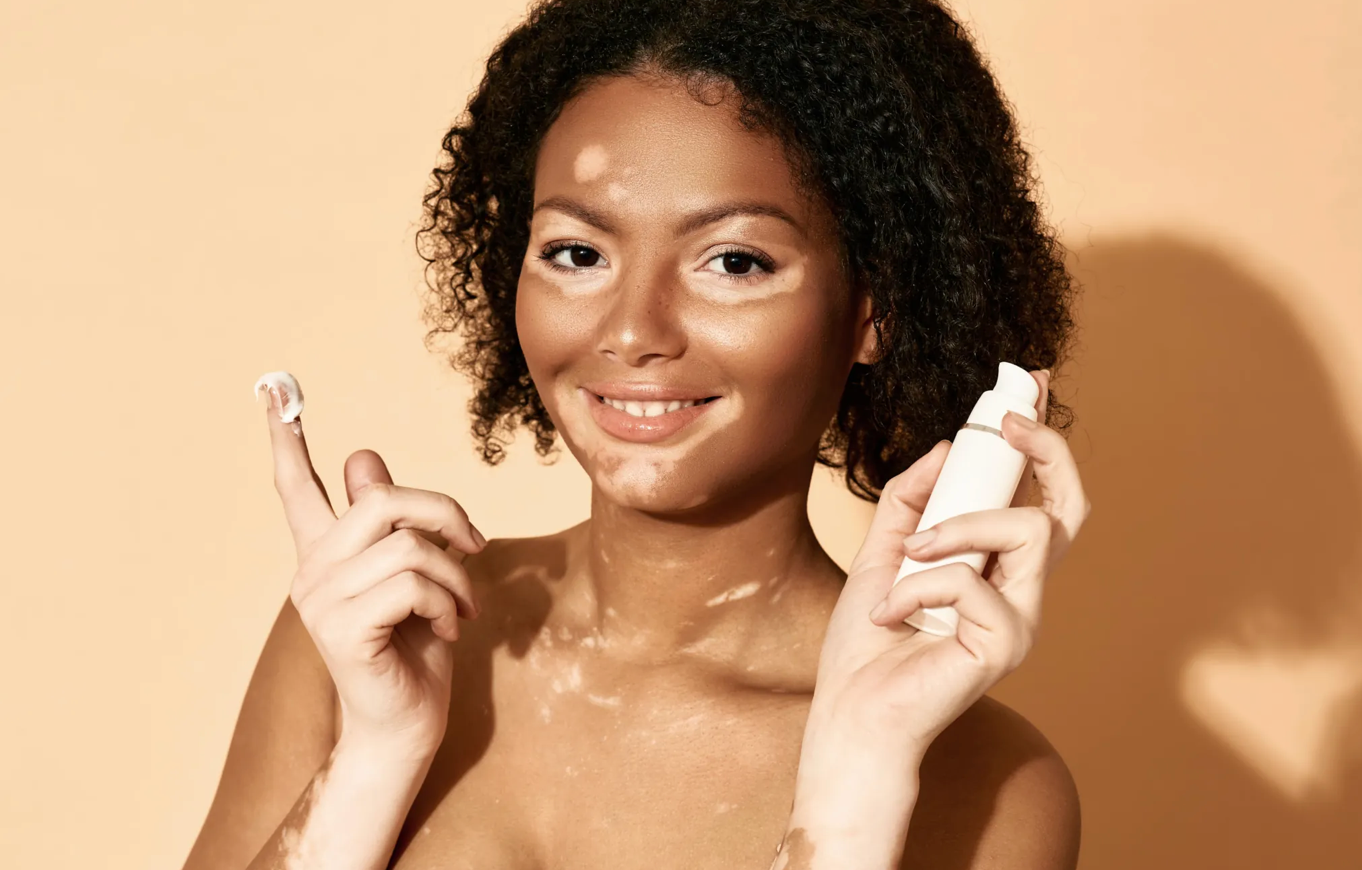 Living With Vitiligo: What Your Skin Is Telling You and How to Support It