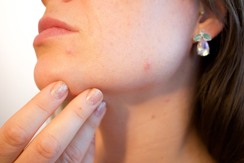 4 Easy Acne Treatments That Actually Work
