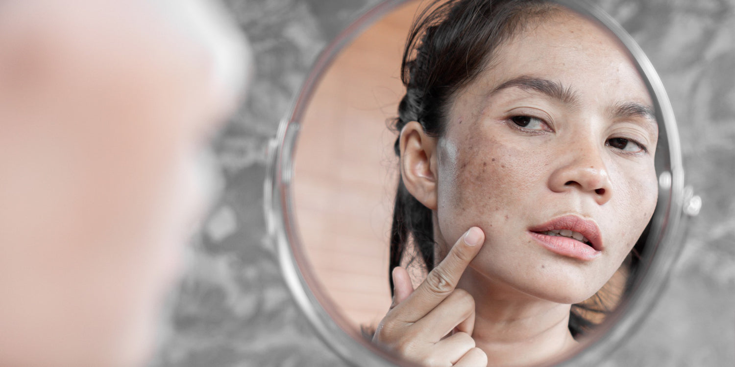 Hyperpigmentation: Causes, Product Recommendations, & Treatments