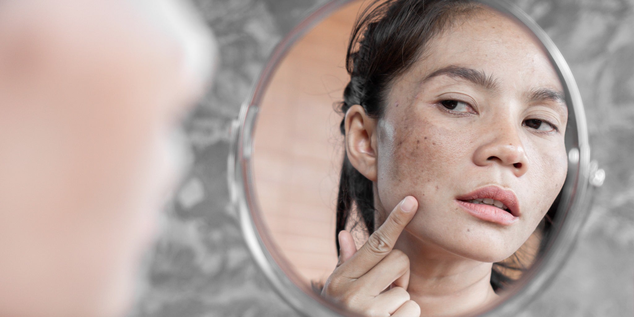 Hyperpigmentation: Causes, Product Recommendations, & Treatments