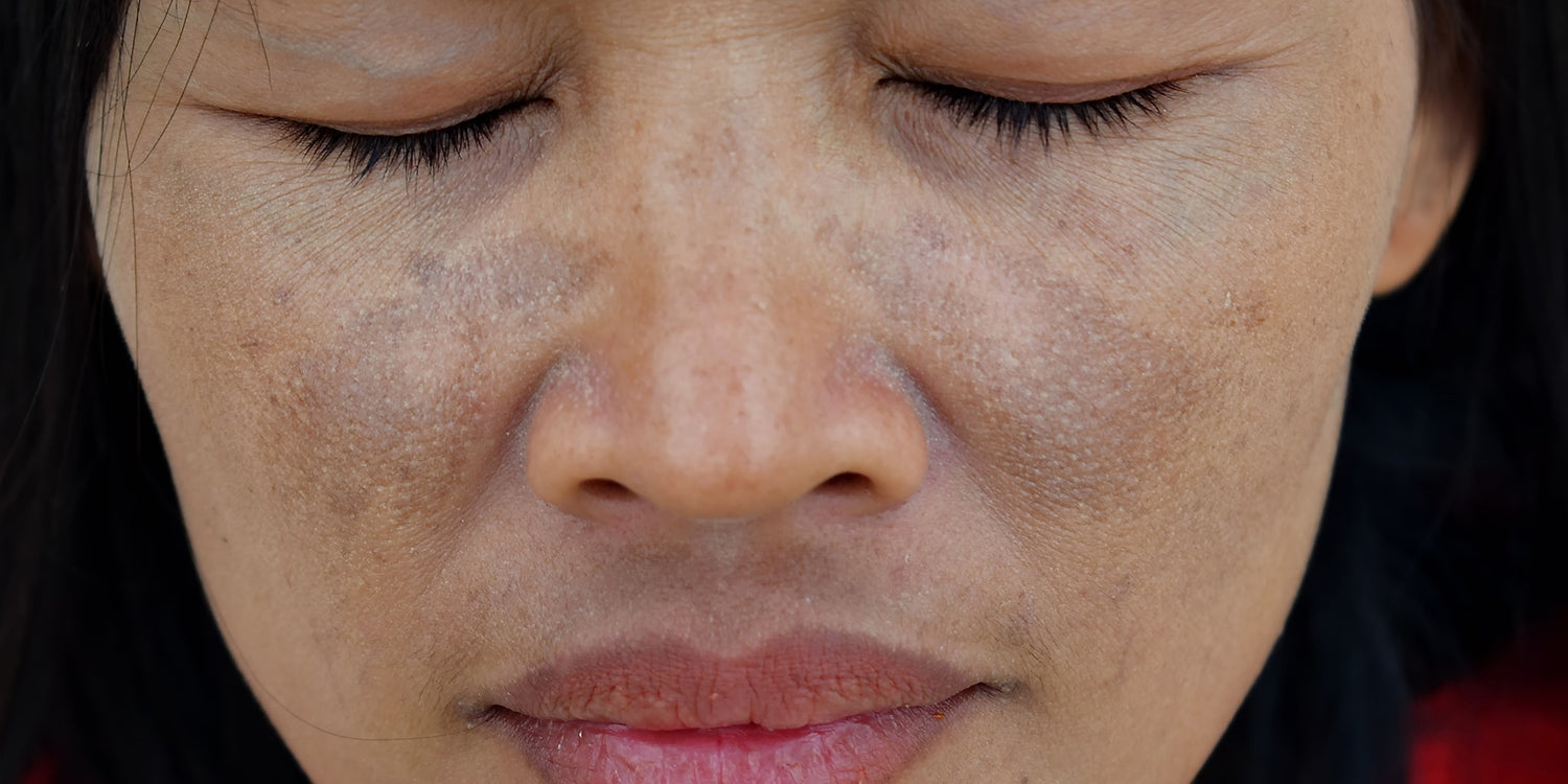 3 Dermatologist Approved Tips For Treating Hyperpigmentation--They Work SO Fast!