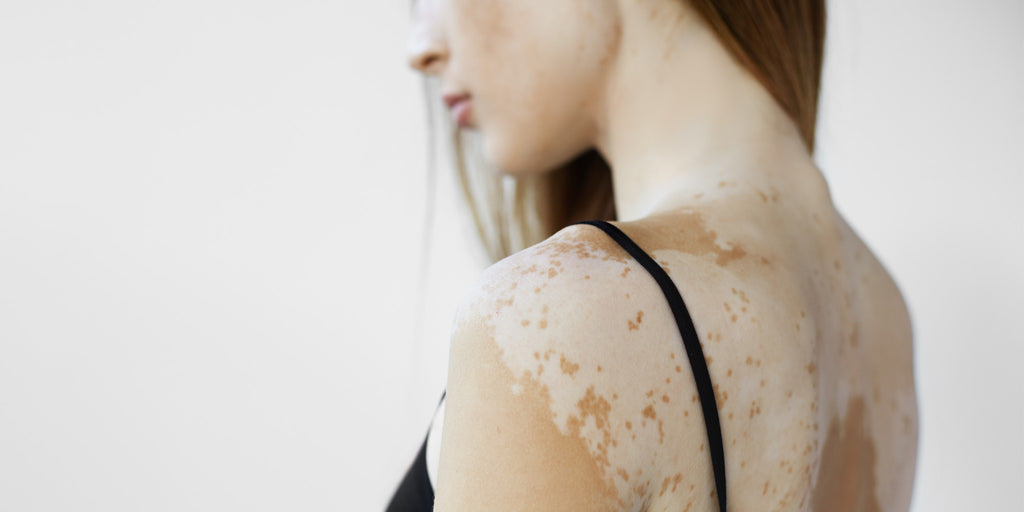 Everything to Know About Vitiligo, Including How to Best Treat It