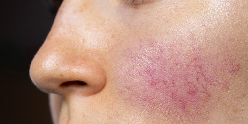 Rosacea: What To Avoid & The Best Derm-Approved Treatments