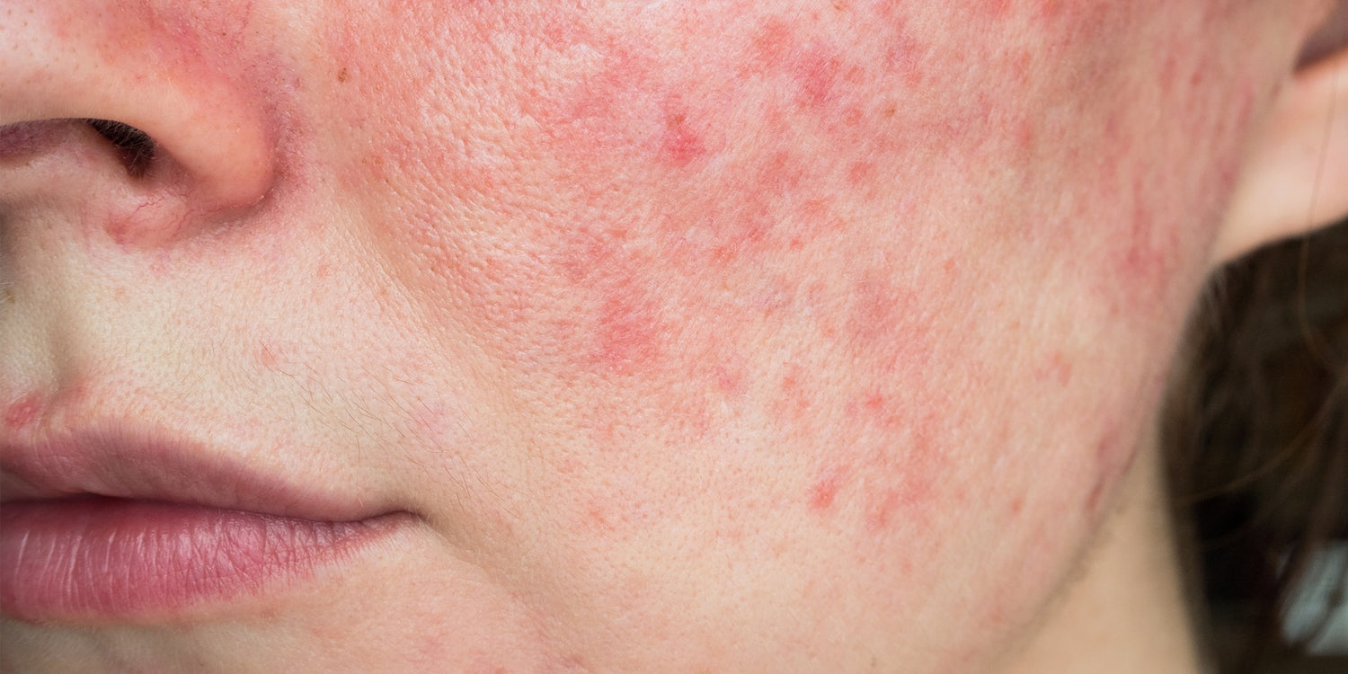 Is Rosacea An Autoimmune Disease? Top Memphis Doc Says Maybe