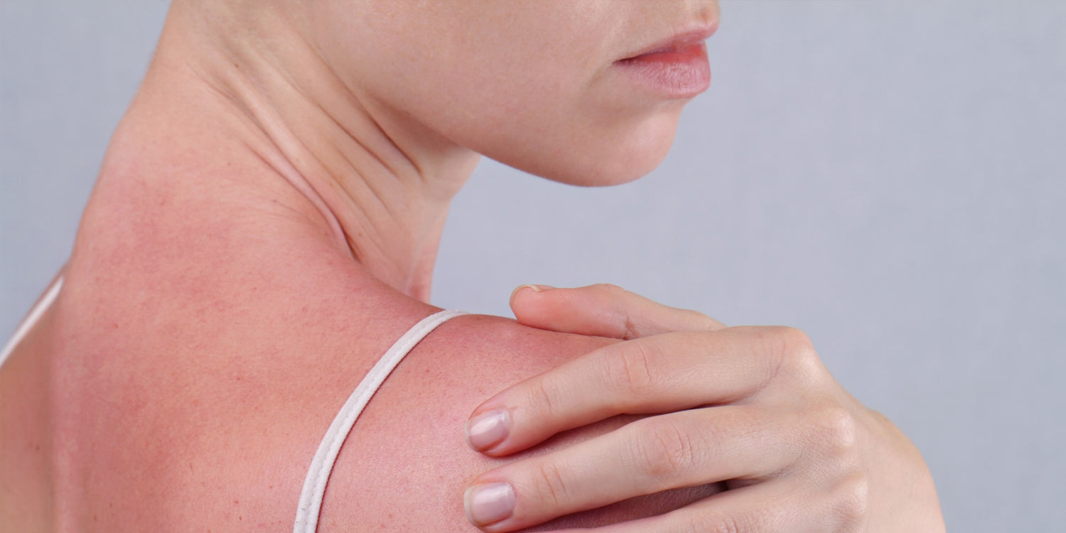 Sun Damage Looks Different On Every Skin Tone—Here's What Experts Say You Should Look For